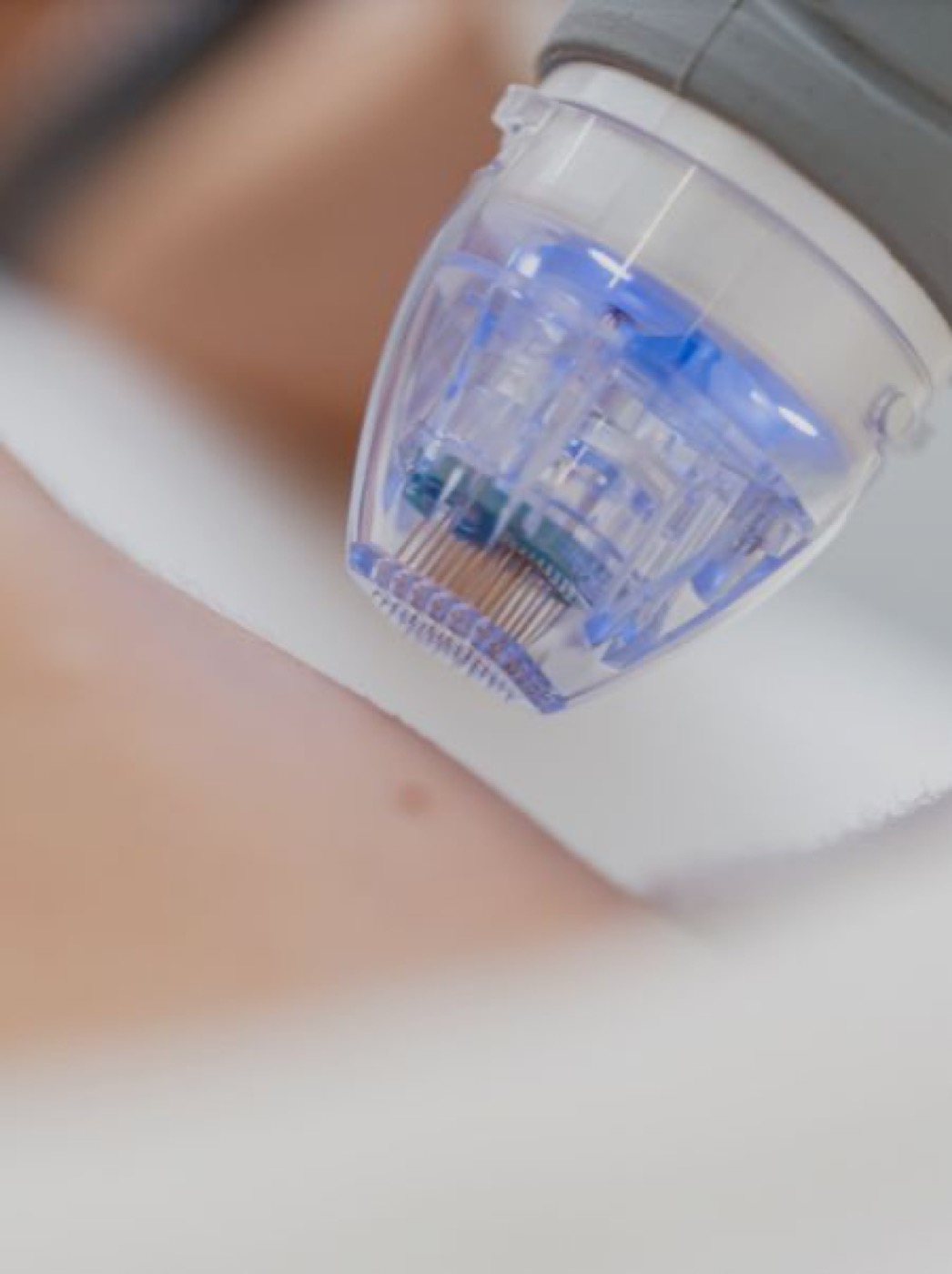 Microneedling Behandlung bei Cornelia Brandt Kosmetik