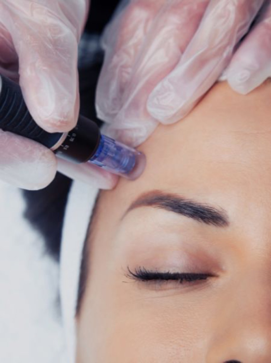 Microneedling bei Cornelia Brandt Kosmetik, natürliches Lifting